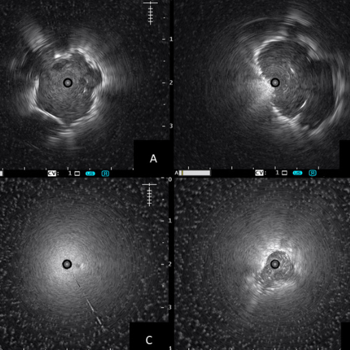 Radial EBUS Procedure Image